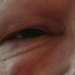 Hives, Hives and More Hives