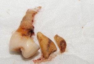tooth_002_wideweb__470x321,0